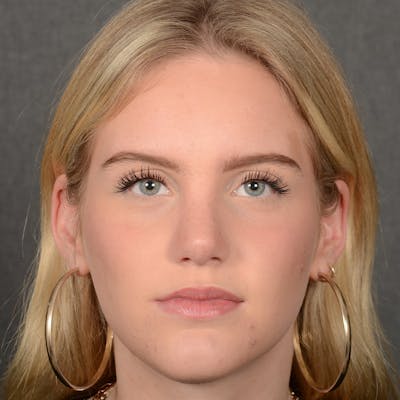 Female Rhinoplasty Before & After Gallery - Patient 248764 - Image 2