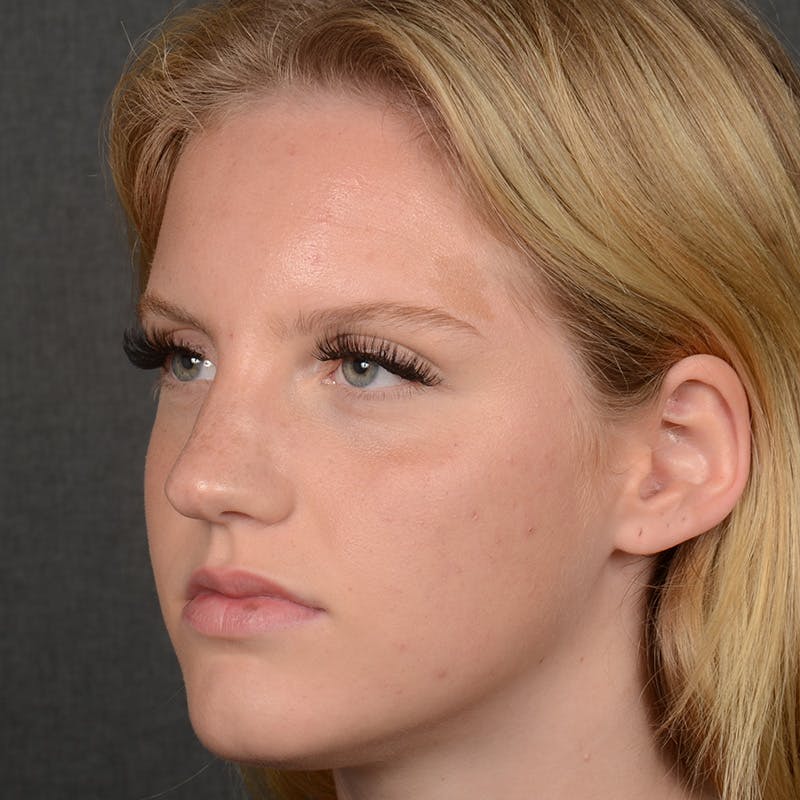 Female Rhinoplasty Before & After Gallery - Patient 248764 - Image 3