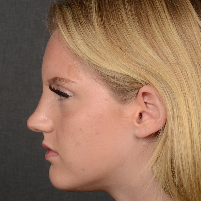 Female Rhinoplasty Before & After Gallery - Patient 248764 - Image 5