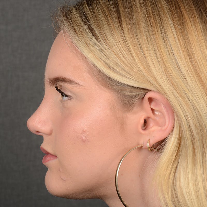 Female Rhinoplasty Before & After Gallery - Patient 248764 - Image 6