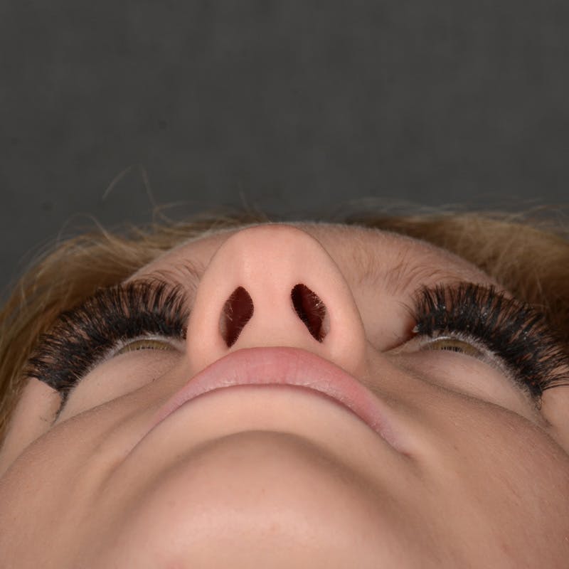 Female Rhinoplasty Before & After Gallery - Patient 248764 - Image 7