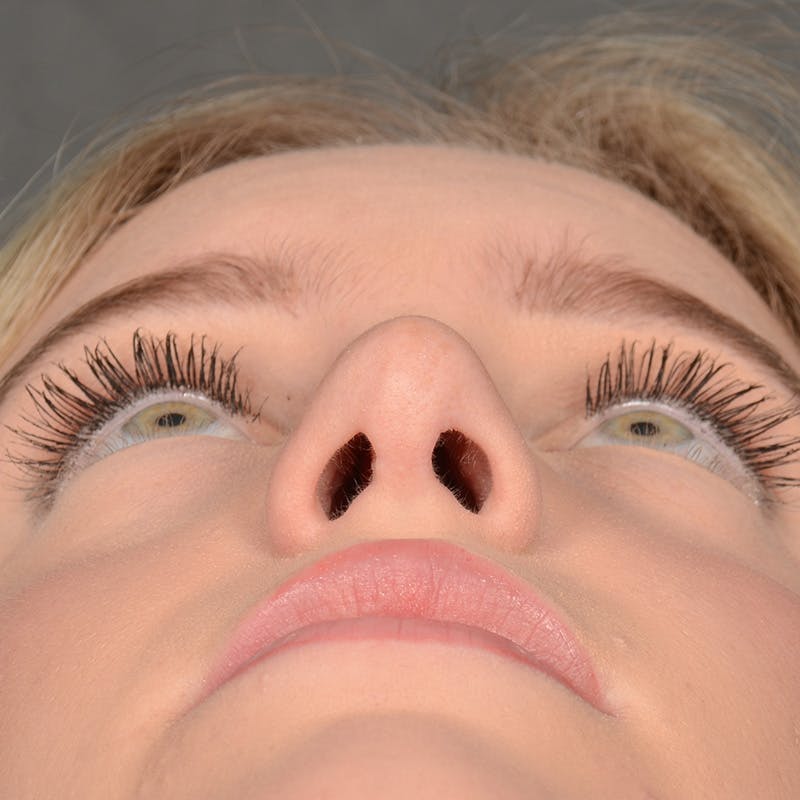 Female Rhinoplasty Before & After Gallery - Patient 248764 - Image 8
