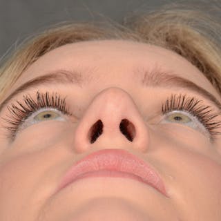 Female Rhinoplasty Before & After Gallery - Patient 248764 - Image 8
