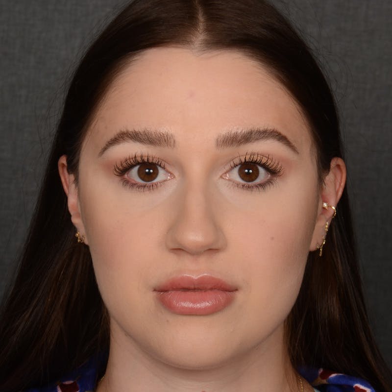 Female Rhinoplasty Before & After Gallery - Patient 374624 - Image 1