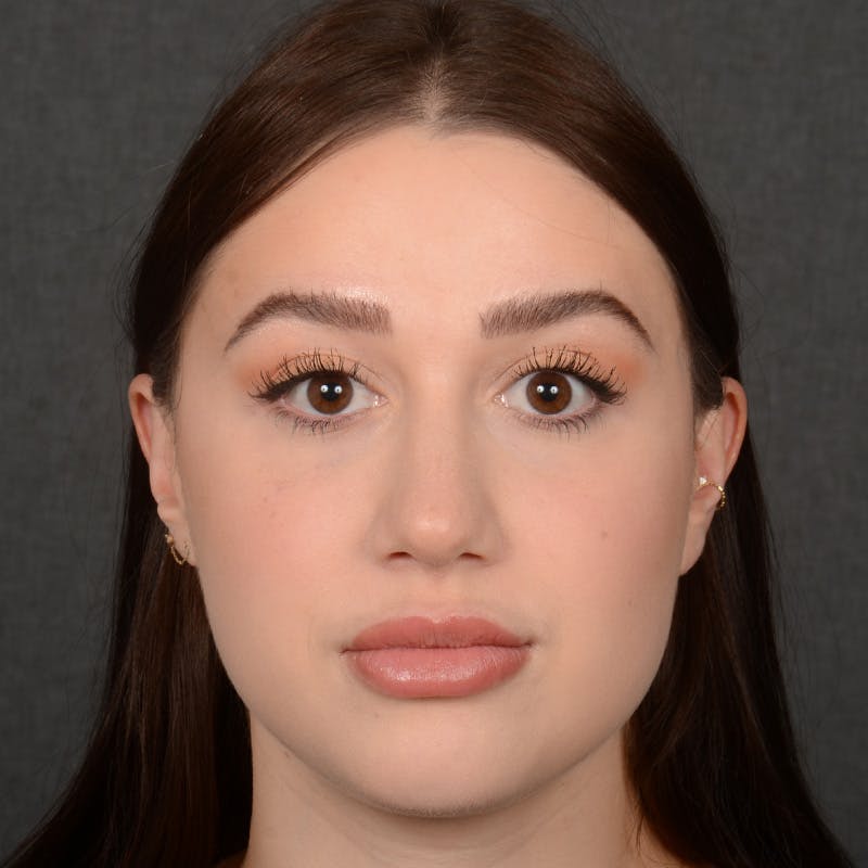 Female Rhinoplasty Before & After Gallery - Patient 374624 - Image 2