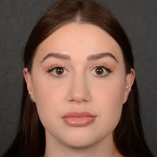 Female Rhinoplasty Before & After Gallery - Patient 374624 - Image 2