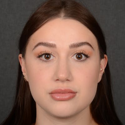 Female Rhinoplasty Before & After Gallery - Patient 374624 - Image 2