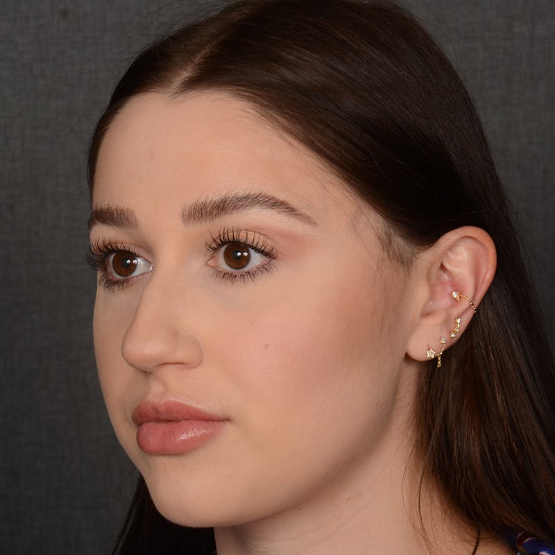 Female Rhinoplasty Before & After Gallery - Patient 374624 - Image 3