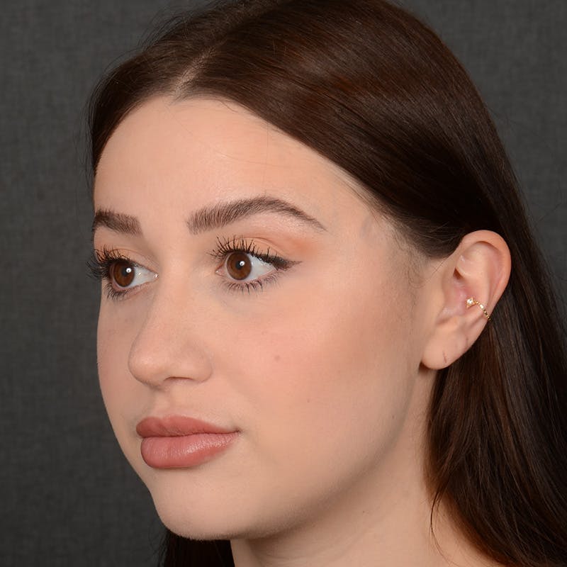 Female Rhinoplasty Before & After Gallery - Patient 374624 - Image 4