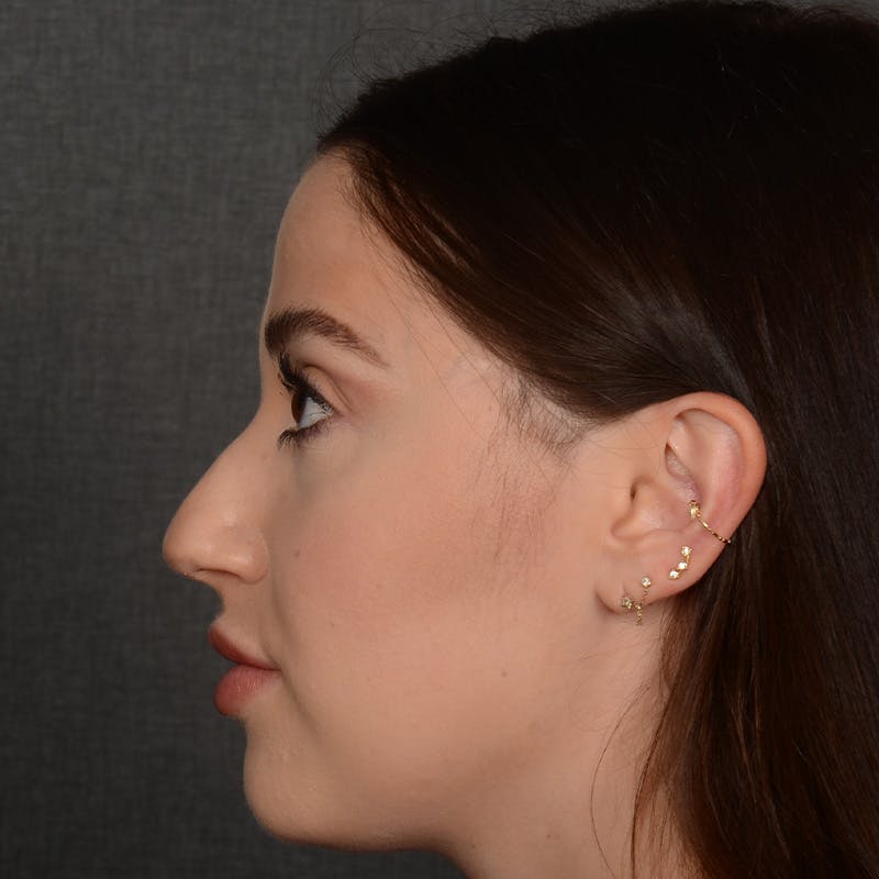 Female Rhinoplasty Before & After Gallery - Patient 374624 - Image 5