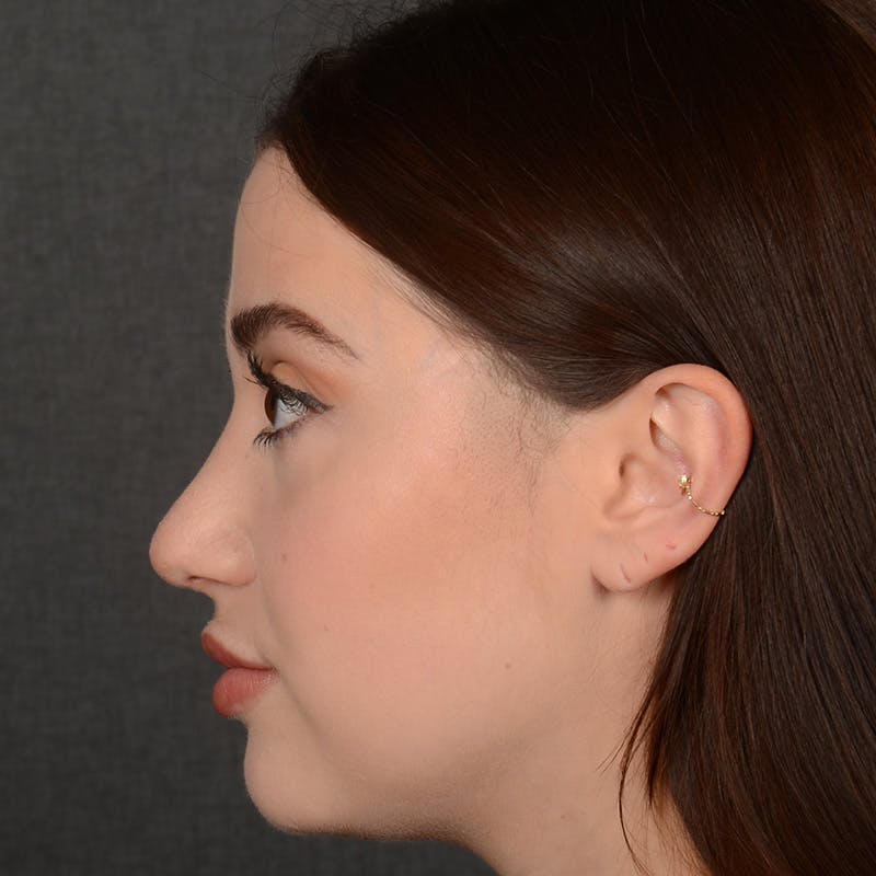 Female Rhinoplasty Before & After Gallery - Patient 374624 - Image 6