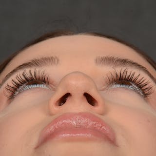 Female Rhinoplasty Before & After Gallery - Patient 374624 - Image 8