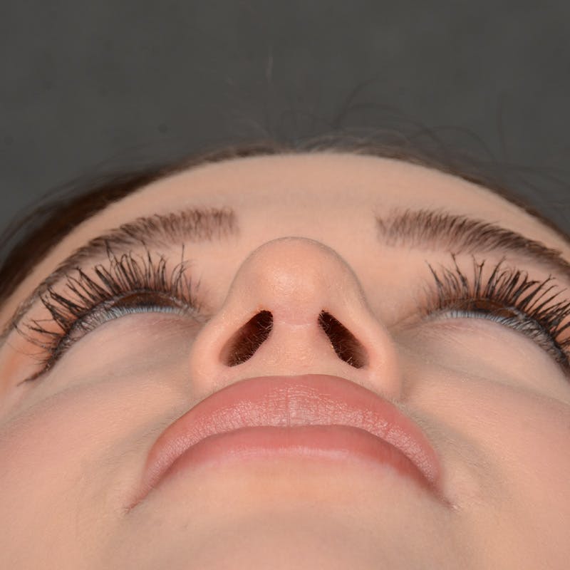 Female Rhinoplasty Before & After Gallery - Patient 374624 - Image 7