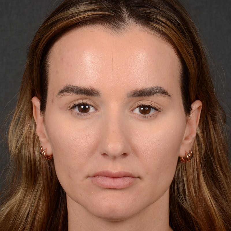 Female Rhinoplasty Before & After Gallery - Patient 141852 - Image 1