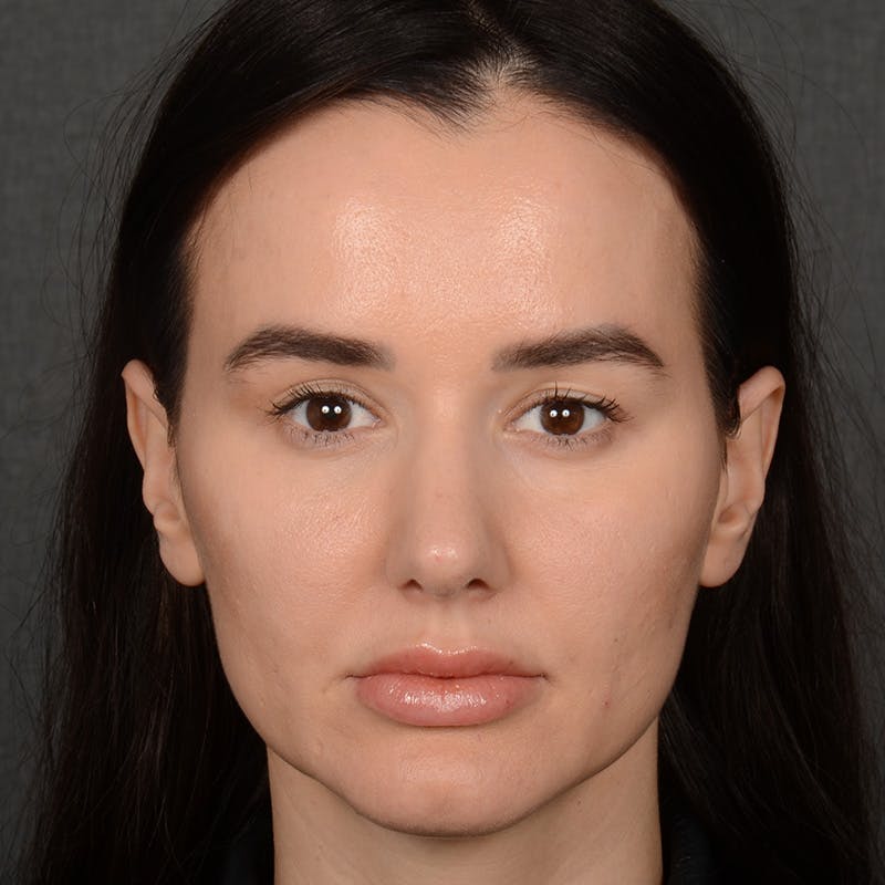 Female Rhinoplasty Before & After Gallery - Patient 141852 - Image 2