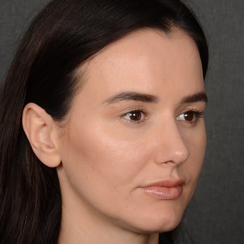 Female Rhinoplasty Before & After Gallery - Patient 141852 - Image 4