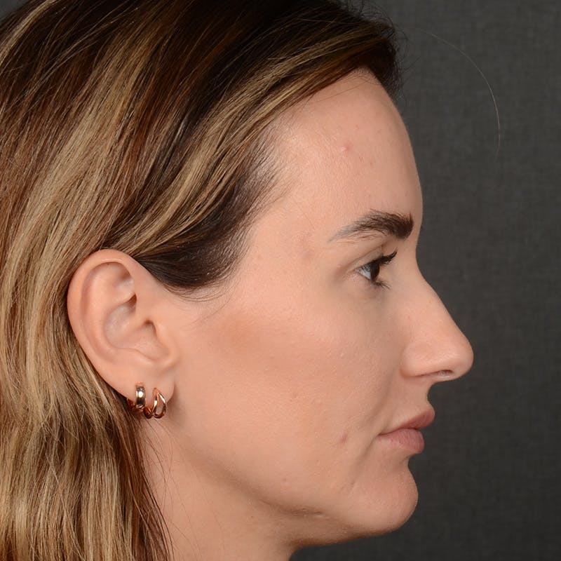 Female Rhinoplasty Before & After Gallery - Patient 141852 - Image 5