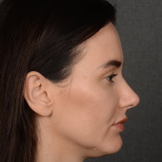 Female Rhinoplasty Before & After Gallery - Patient 141852 - Image 6