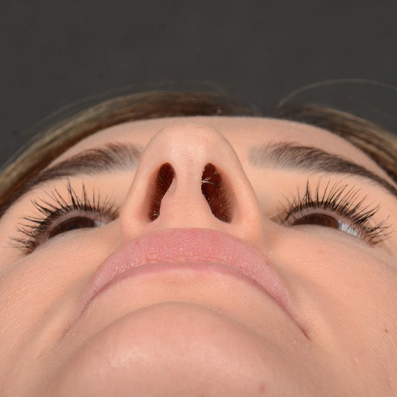 Female Rhinoplasty Before & After Gallery - Patient 141852 - Image 7