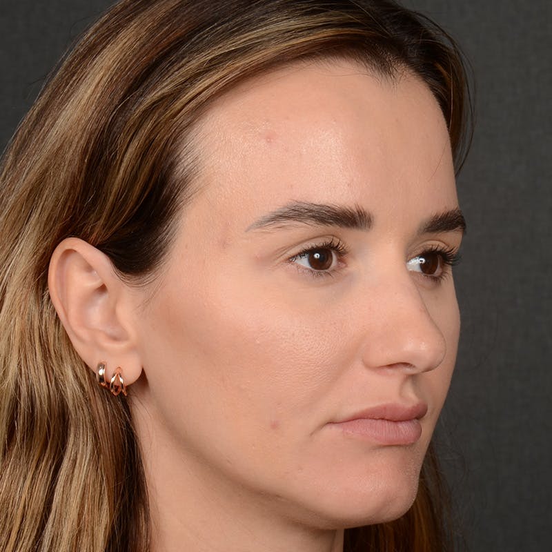 Female Rhinoplasty Before & After Gallery - Patient 141852 - Image 3