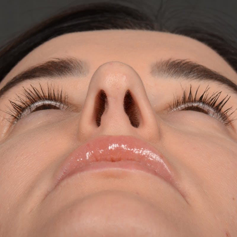 Female Rhinoplasty Before & After Gallery - Patient 141852 - Image 8