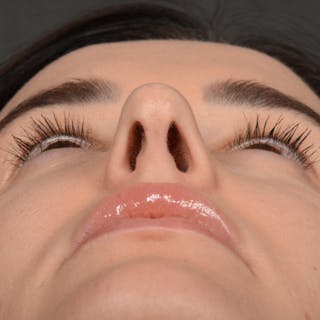 Female Rhinoplasty Before & After Gallery - Patient 141852 - Image 8