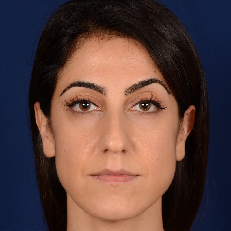 Female Rhinoplasty Before & After Gallery - Patient 344783 - Image 1