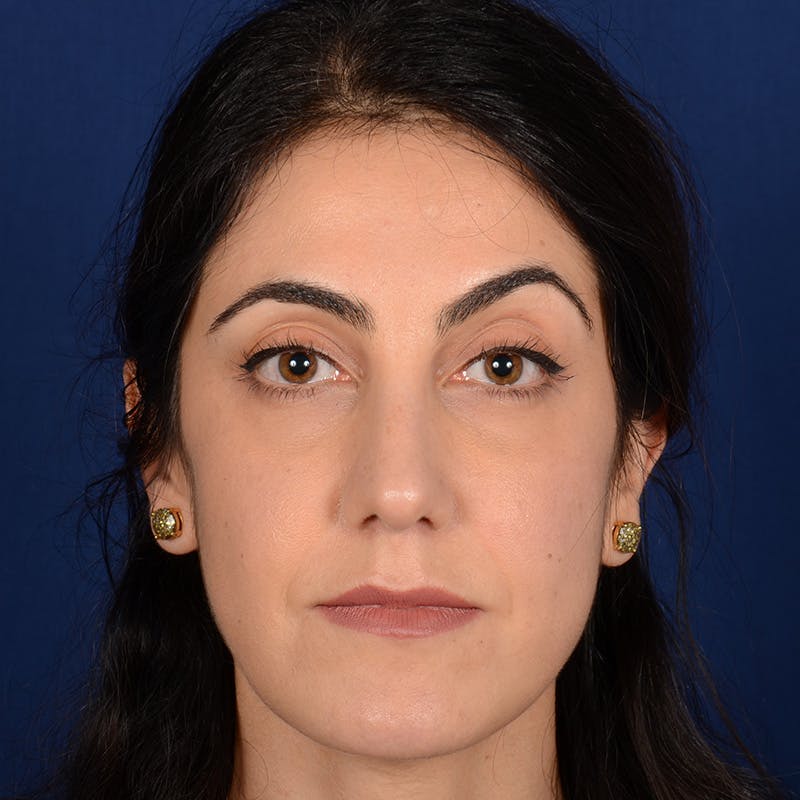 Female Rhinoplasty Before & After Gallery - Patient 344783 - Image 2