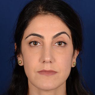 Female Rhinoplasty Before & After Gallery - Patient 344783 - Image 2