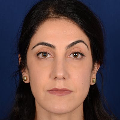 Female Rhinoplasty Before & After Gallery - Patient 344783 - Image 2