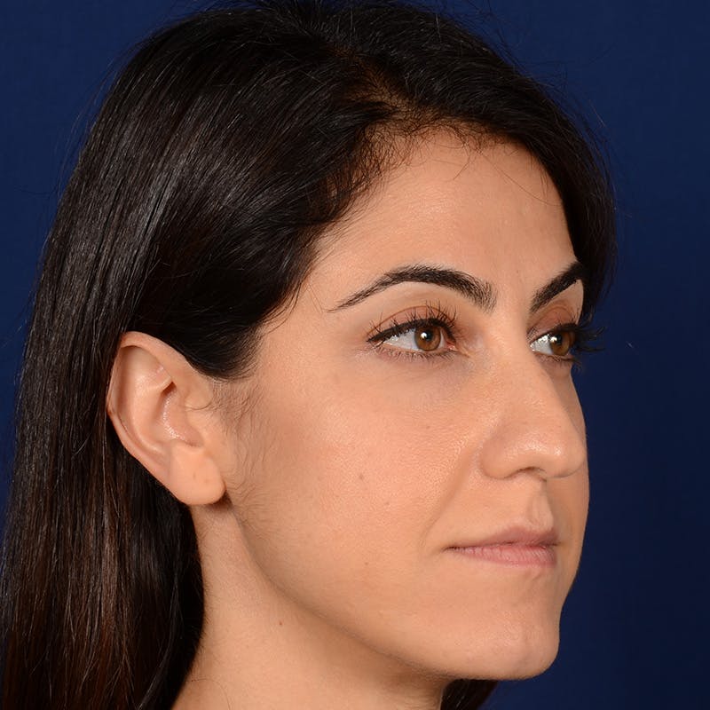 Female Rhinoplasty Before & After Gallery - Patient 344783 - Image 3