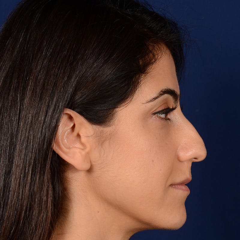 Female Rhinoplasty Before & After Gallery - Patient 344783 - Image 5