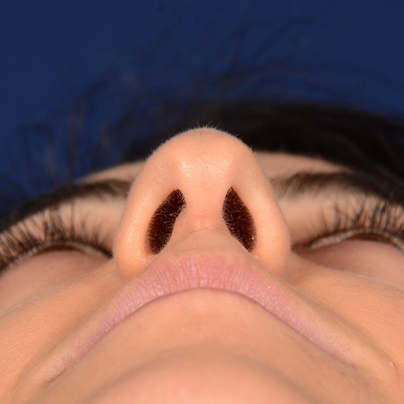 Female Rhinoplasty Before & After Gallery - Patient 344783 - Image 7
