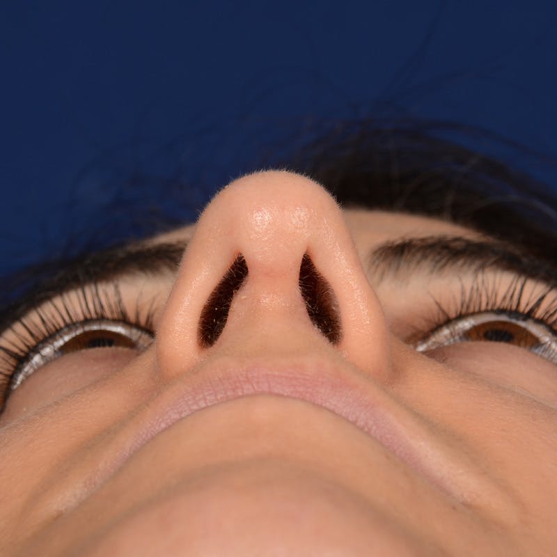 Female Rhinoplasty Before & After Gallery - Patient 344783 - Image 8