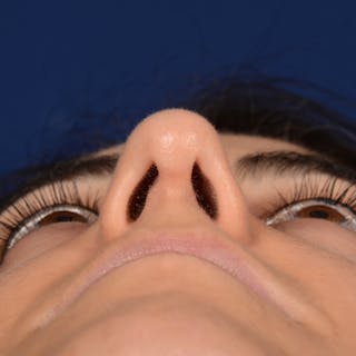 Female Rhinoplasty Before & After Gallery - Patient 344783 - Image 8