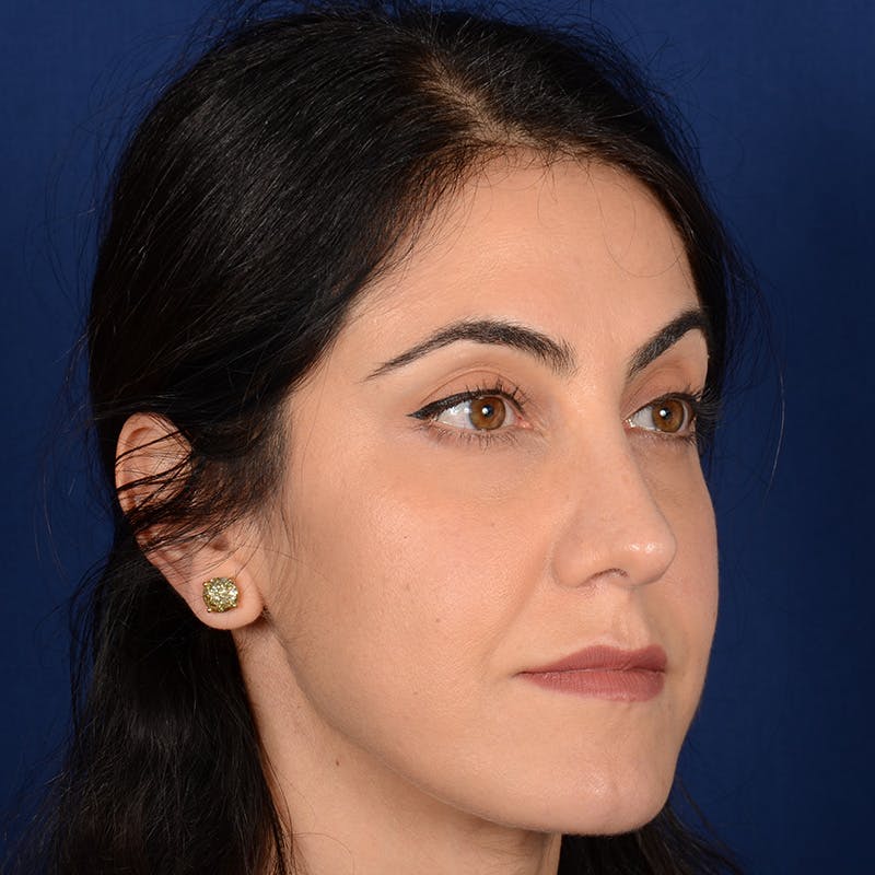 Female Rhinoplasty Before & After Gallery - Patient 344783 - Image 4