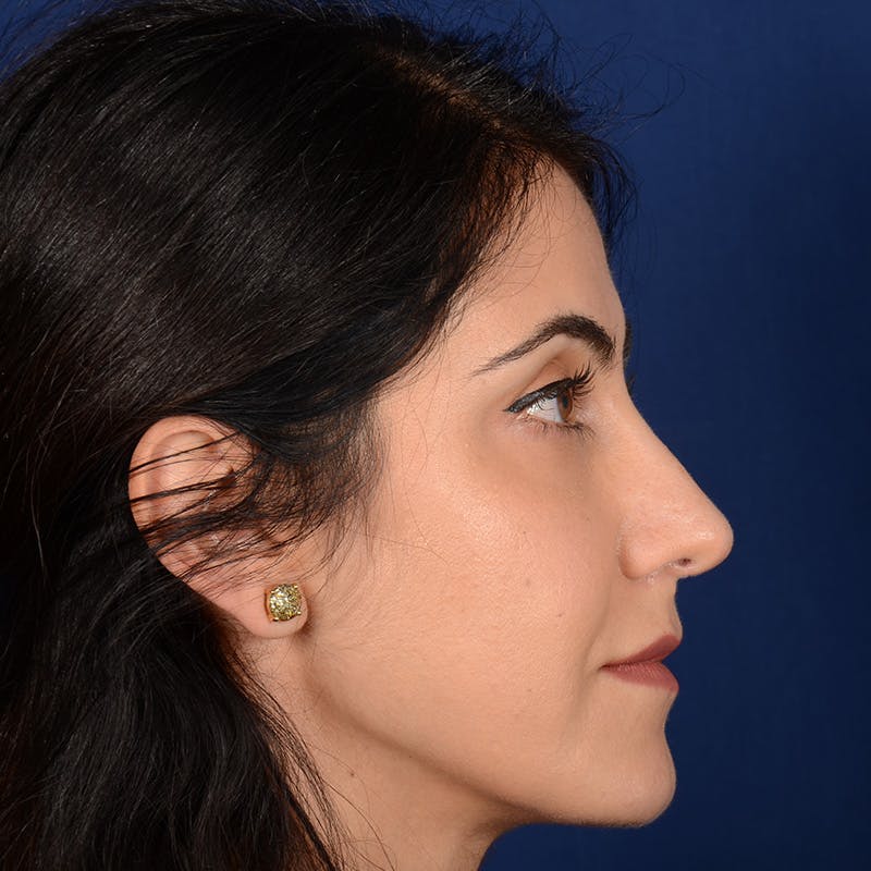 Female Rhinoplasty Before & After Gallery - Patient 344783 - Image 6