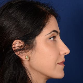 Female Rhinoplasty Before & After Gallery - Patient 344783 - Image 6