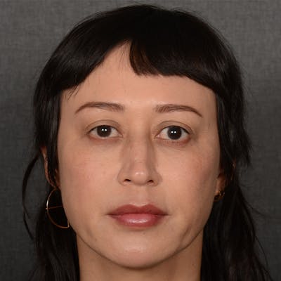 Female Rhinoplasty Before & After Gallery - Patient 181081 - Image 1