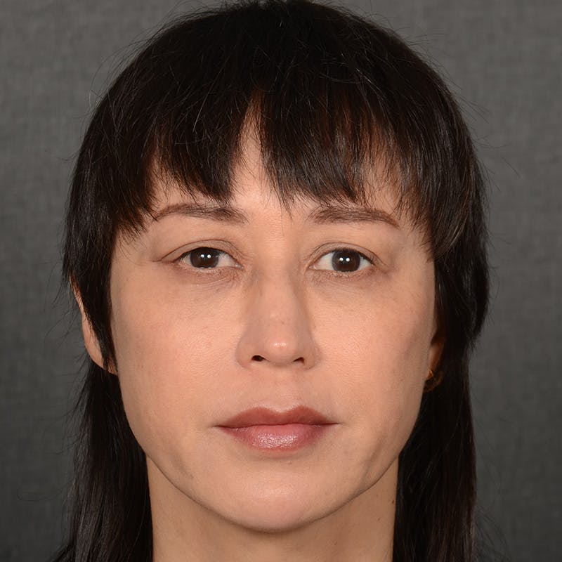 Female Rhinoplasty Before & After Gallery - Patient 181081 - Image 2