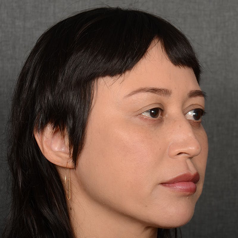 Female Rhinoplasty Before & After Gallery - Patient 181081 - Image 3