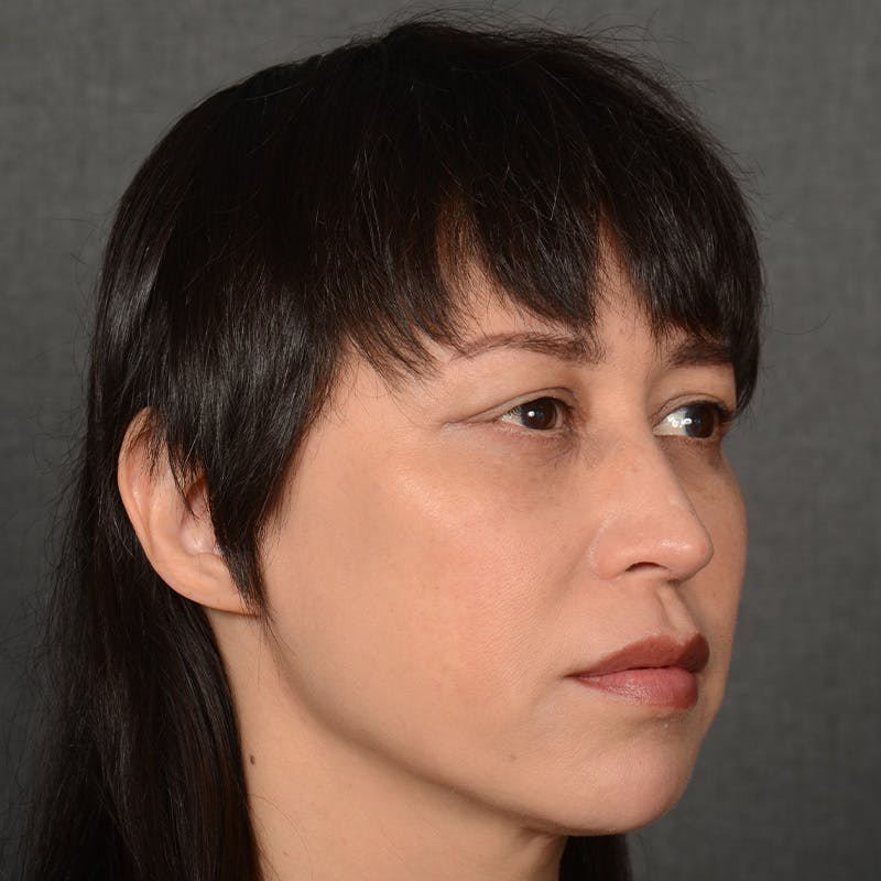Female Rhinoplasty Before & After Gallery - Patient 181081 - Image 4