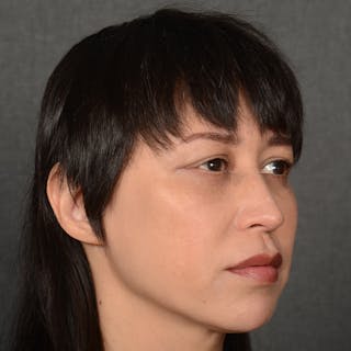 Female Rhinoplasty Before & After Gallery - Patient 181081 - Image 4