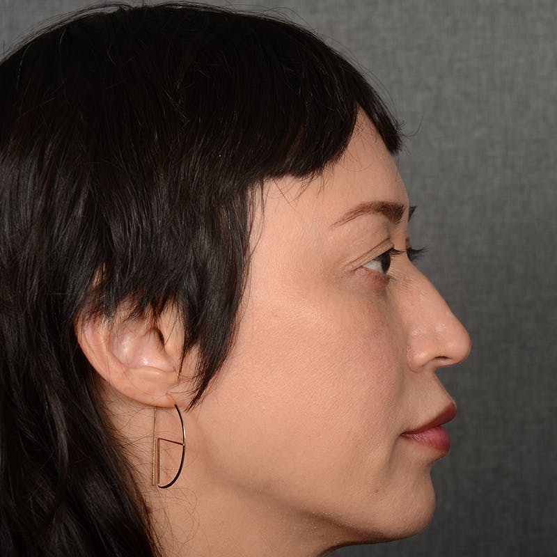 Female Rhinoplasty Before & After Gallery - Patient 181081 - Image 5