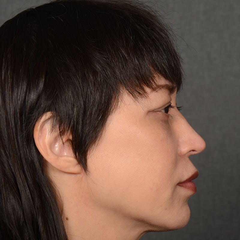 Female Rhinoplasty Before & After Gallery - Patient 181081 - Image 6