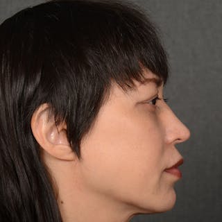 Female Rhinoplasty Before & After Gallery - Patient 181081 - Image 6