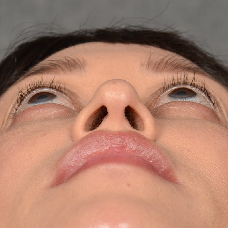 Female Rhinoplasty Before & After Gallery - Patient 181081 - Image 7