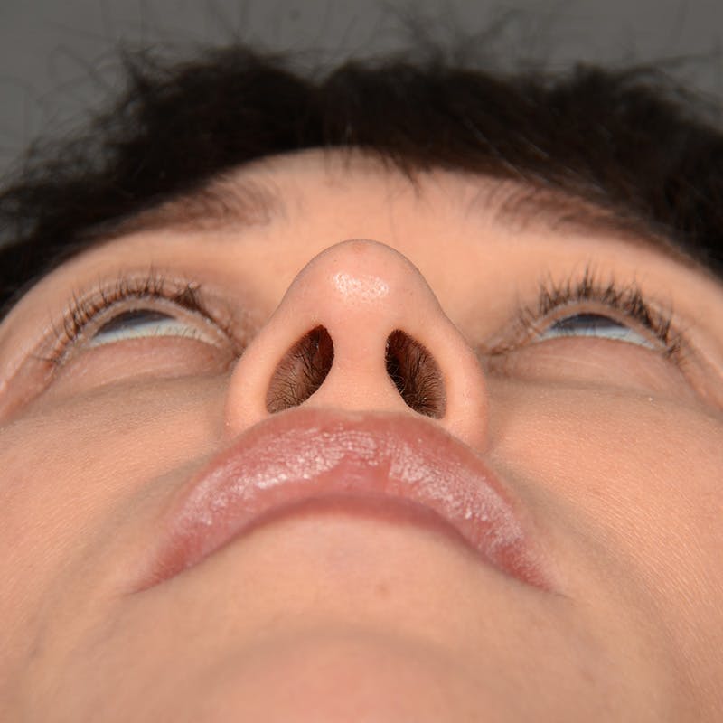 Female Rhinoplasty Before & After Gallery - Patient 181081 - Image 8