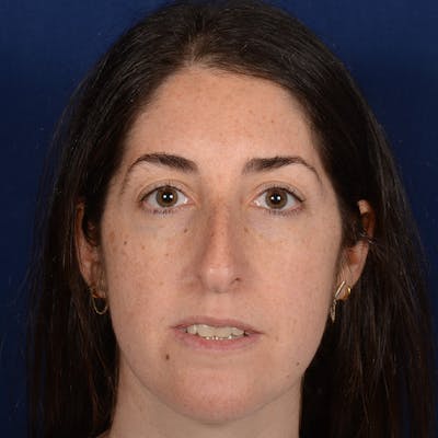 Female Rhinoplasty Before & After Gallery - Patient 566971 - Image 1
