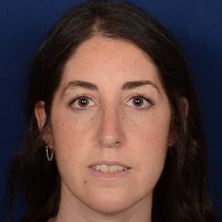 Female Rhinoplasty Before & After Gallery - Patient 566971 - Image 2